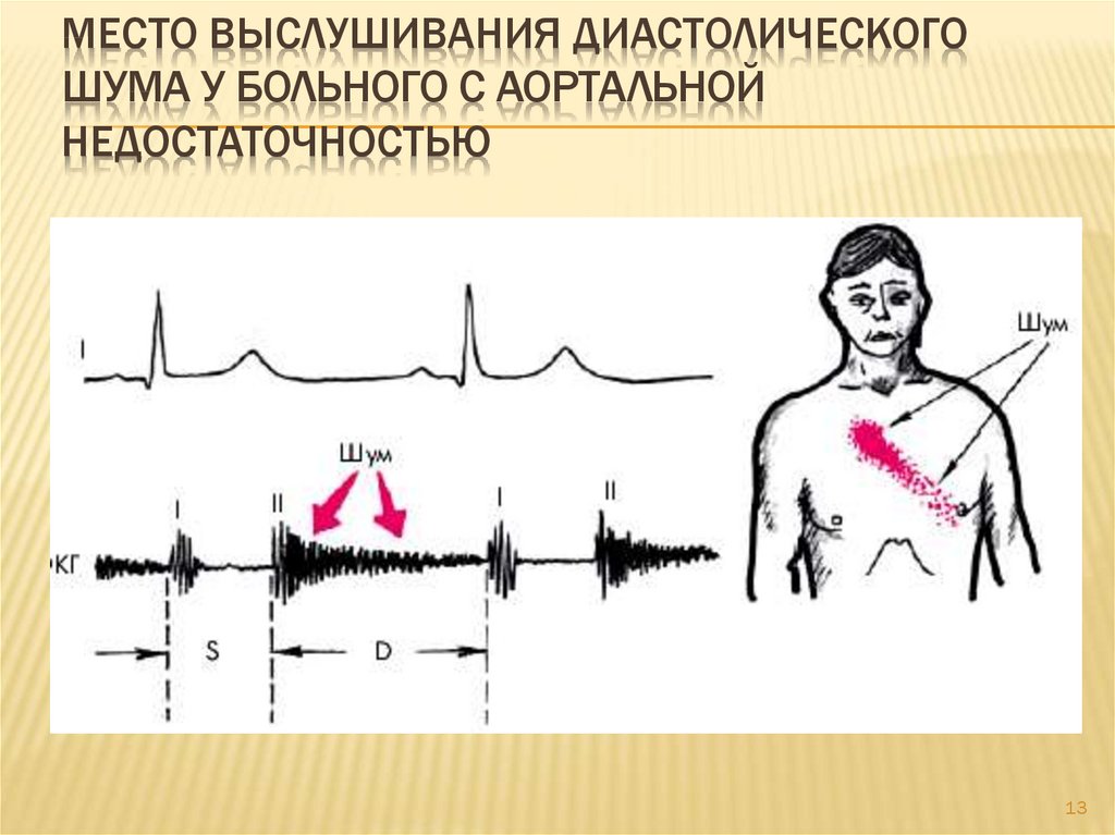 Аускультативная картина. Недостаточность аортального клапана ФКГ. Точки наилучшего выслушивания шума аортальной недостаточности. Недостаточность аортального клапана аускультация. Недостаточность аортального клапана шум.